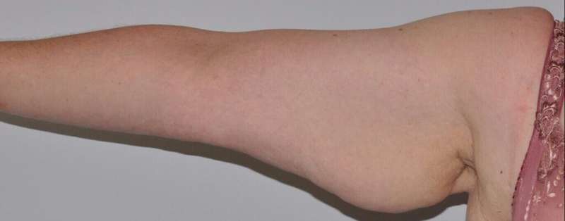 Brachioplasty (Arm Lift) Before & After Patient #1166