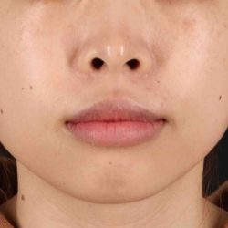 Lip Reduction Before & After Patient #6222