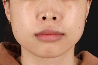 Lip Reduction Before & After Patient #6222