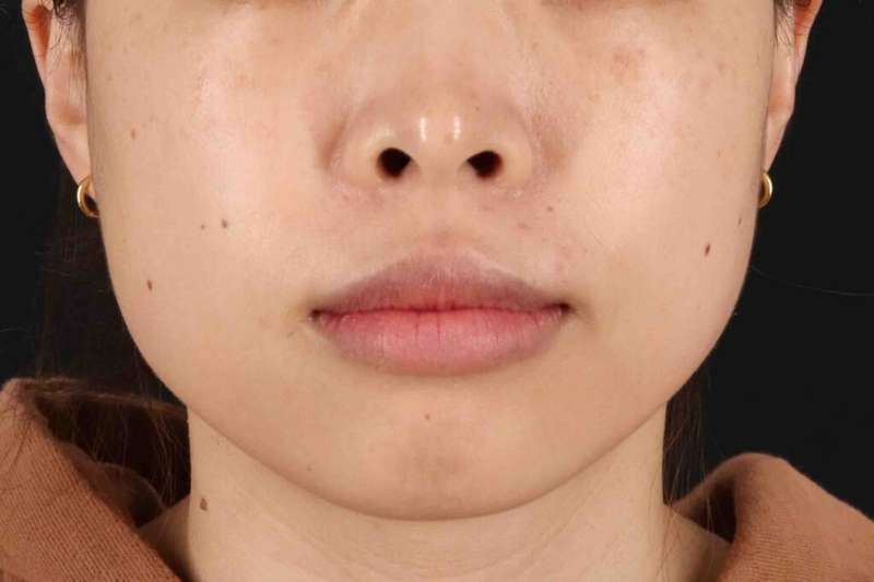 Lip Reduction Before & After Patient #6222