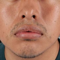 Lip Reduction Before & After Patient #6233