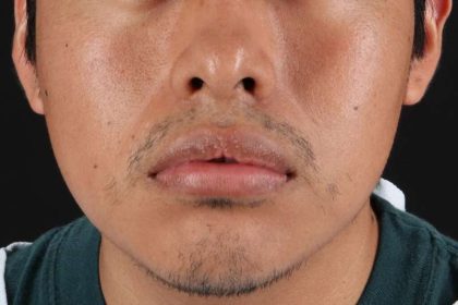 Lip Reduction Before & After Patient #6233