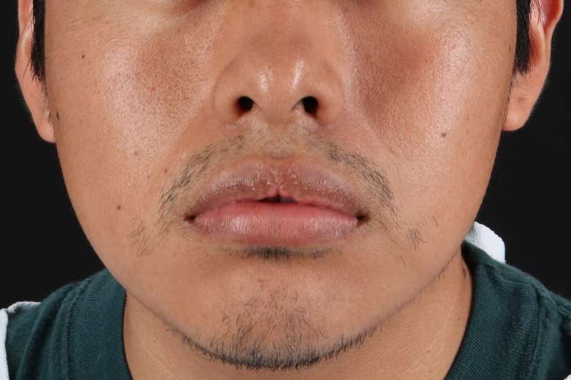 Lip Reduction Before & After Patient #6233