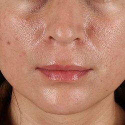 Lip Lift Before & After Patient #6244