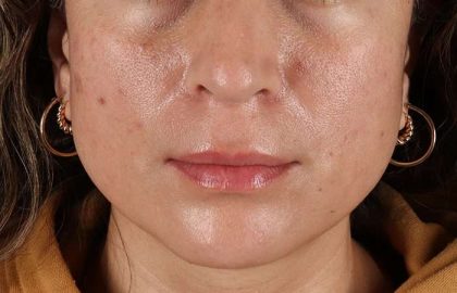 Lip Lift Before & After Patient #6244