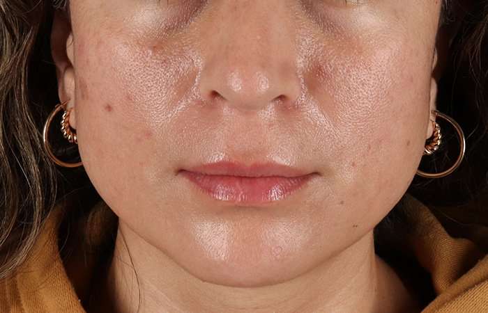 Lip Lift Before & After Patient #6244