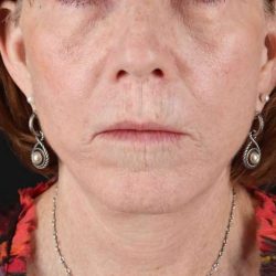 Lip Lift Before & After Patient #6255