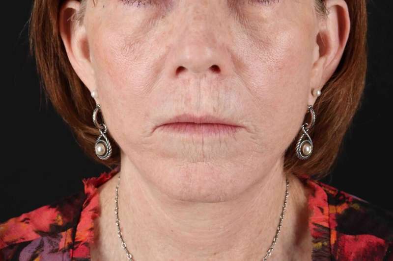 Lip Lift Before & After Patient #6255