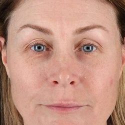 Lip Lift Before & After Patient #6266