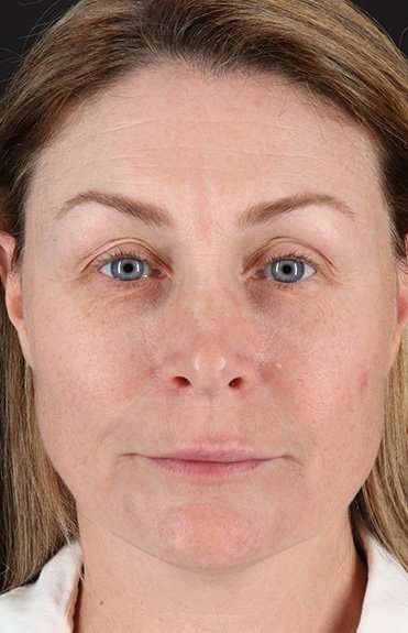 Lip Lift Before & After Patient #6266
