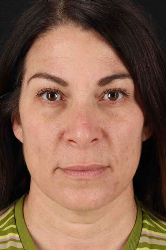 Lip Lift Before & After Patient #6277