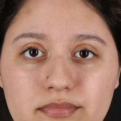 Liquid Rhinoplasty Before & After Patient #6299