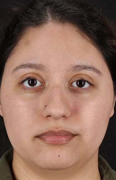 Liquid Rhinoplasty Before & After Patient #6299