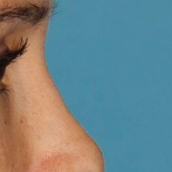 Liquid Rhinoplasty Before & After Patient #6302