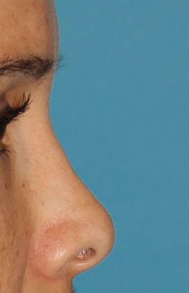 Liquid Rhinoplasty Before & After Patient #6302