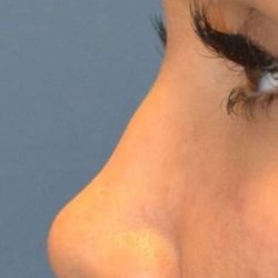 Liquid Rhinoplasty Before & After Patient #6305