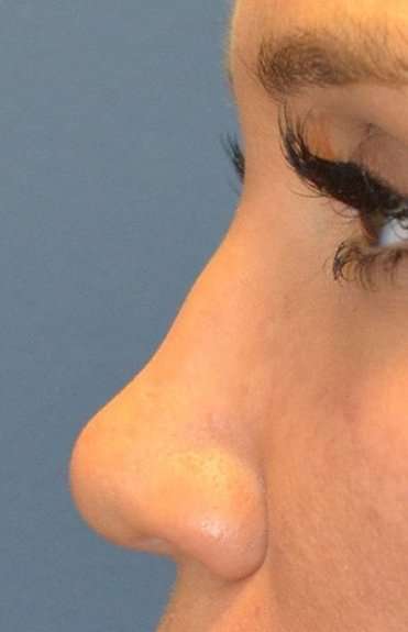 Liquid Rhinoplasty Before & After Patient #6305
