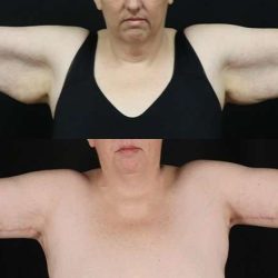Brachioplasty (Arm Lift) Before & After Patient #1169