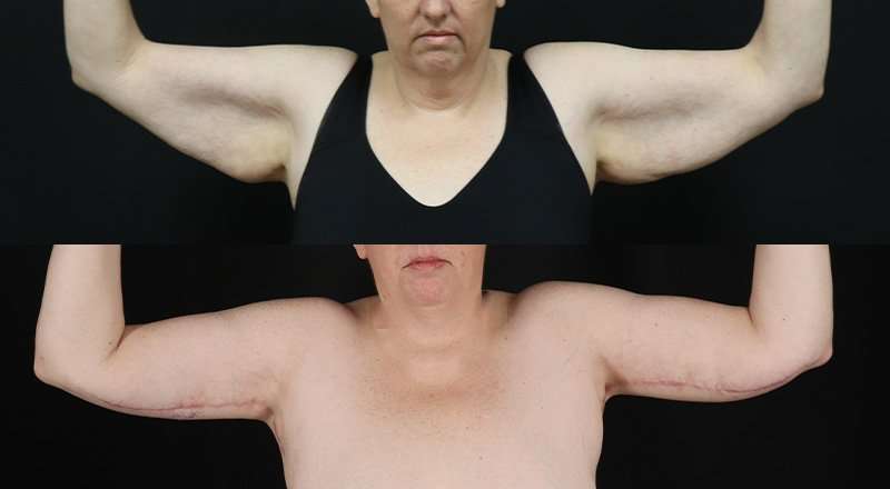 Brachioplasty (Arm Lift) Before & After Patient #1169