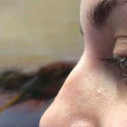 Liquid Rhinoplasty Before & After Patient #6308