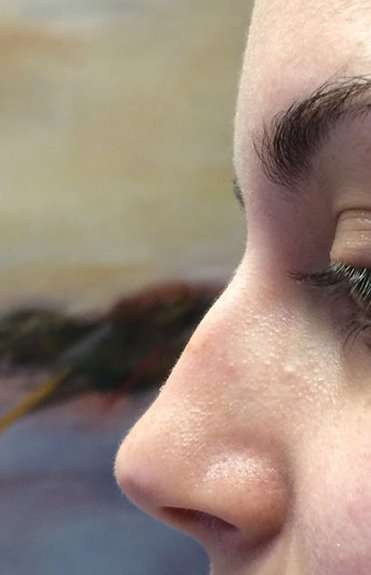 Liquid Rhinoplasty Before & After Patient #6308