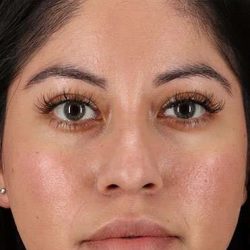 Liquid Rhinoplasty Before & After Patient #6319