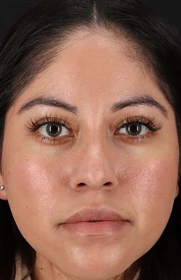 Liquid Rhinoplasty Before & After Patient #6319