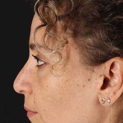 Liquid Rhinoplasty Before & After Patient #6322