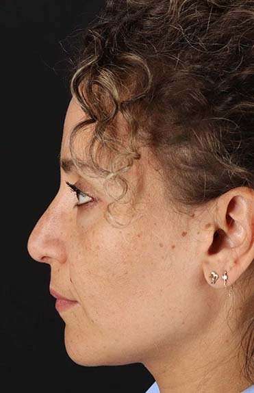 Liquid Rhinoplasty Before & After Patient #6322