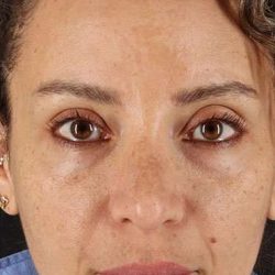 Liquid Rhinoplasty Before & After Patient #6333