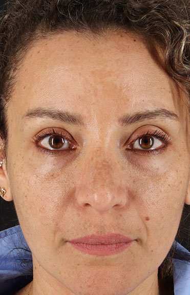 Liquid Rhinoplasty Before & After Patient #6333