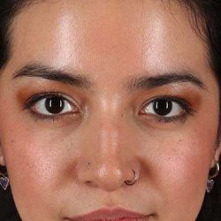 Liquid Rhinoplasty Before & After Patient #6344