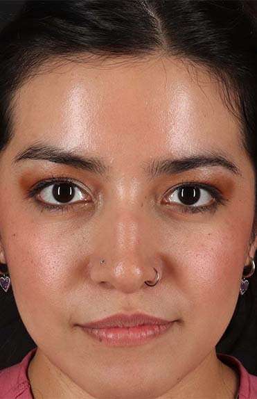 Liquid Rhinoplasty Before & After Patient #6344