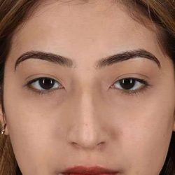 Liquid Rhinoplasty Before & After Patient #6355