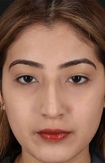 Liquid Rhinoplasty Before & After Patient #6355