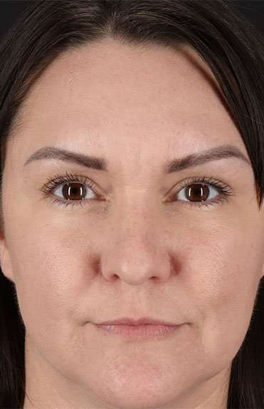 Liquid Rhinoplasty Before & After Patient #6366