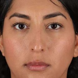 Liquid Rhinoplasty Before & After Patient #6377