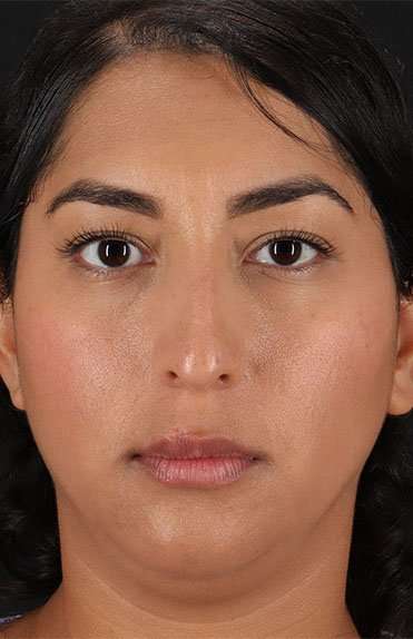 Liquid Rhinoplasty Before & After Patient #6377
