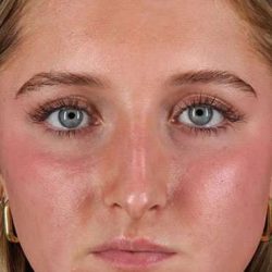 Liquid Rhinoplasty Before & After Patient #6388