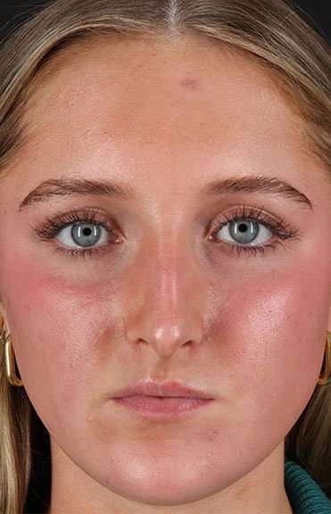 Liquid Rhinoplasty Before & After Patient #6388