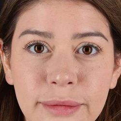 Liquid Rhinoplasty Before & After Patient #6399