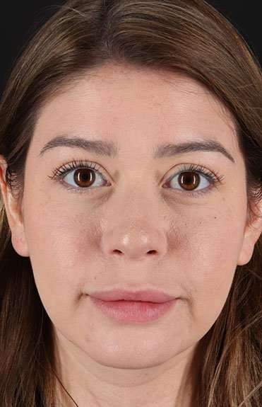 Liquid Rhinoplasty Before & After Patient #6399