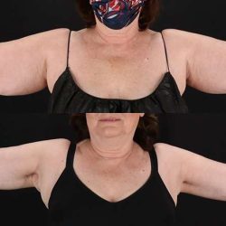 Brachioplasty (Arm Lift) Before & After Patient #1172