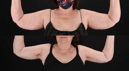 Brachioplasty (Arm Lift) Before & After Patient #1172