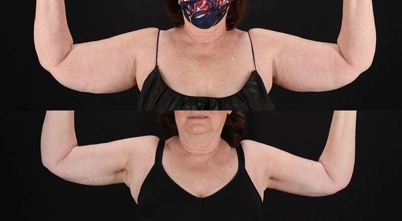 Brachioplasty (Arm Lift) Before & After Patient #1172
