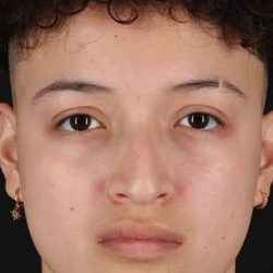 Liquid Rhinoplasty Before & After Patient #6410