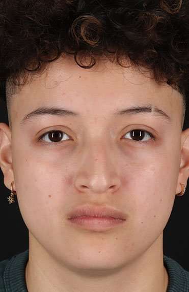 Liquid Rhinoplasty Before & After Patient #6410