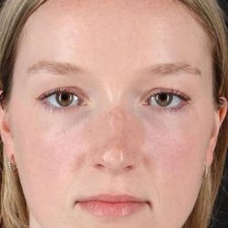 Liquid Rhinoplasty Before & After Patient #6425