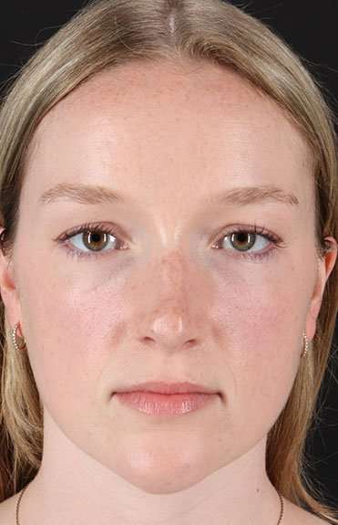 Liquid Rhinoplasty Before & After Patient #6425