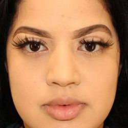 Buccal Fat Pad Before & After Patient #6436